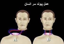 پیوند سر